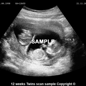 Joke twin baby scan 12 weeks