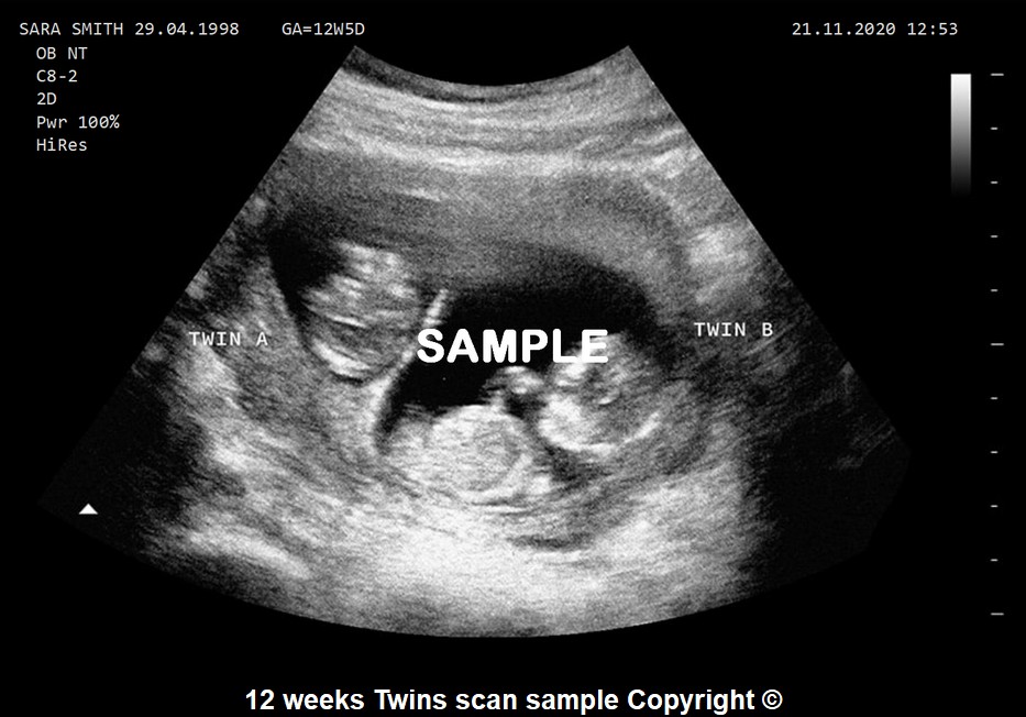 Joke twin baby scan 12 weeks