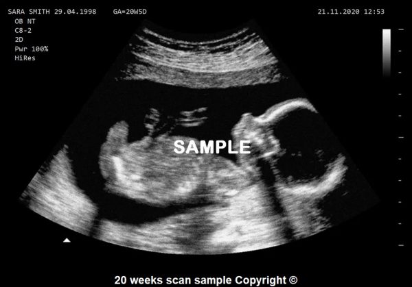 fake baby scan 20 weeks