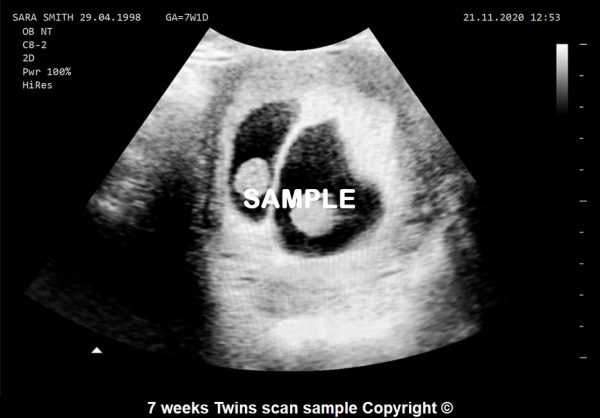 fake twin baby scan 7 weeks