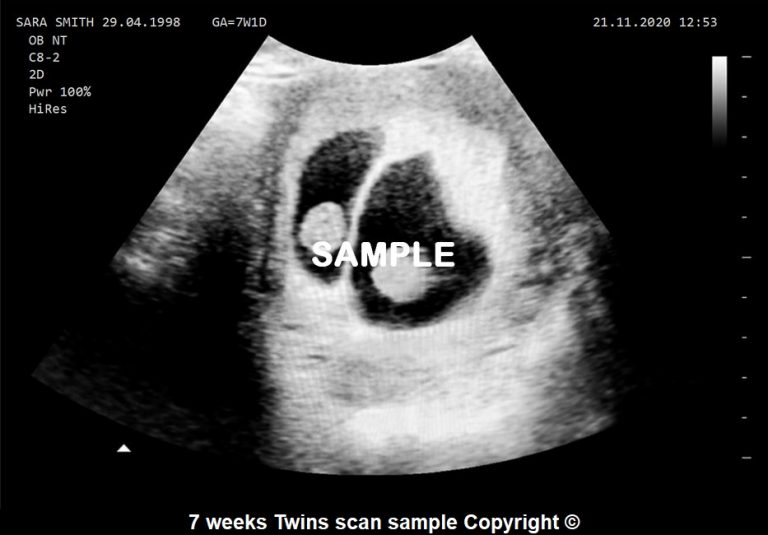 Joke Baby Scan Twins Personalised Ultrasound 7 Weeks Scan Photo Home