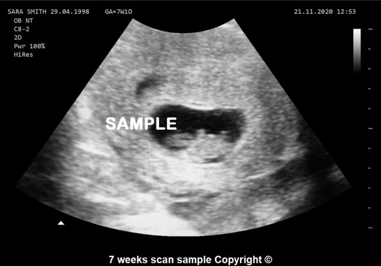 joke-baby-scan-personalised-ultrasound-7-weeks-scan-photo-home-life