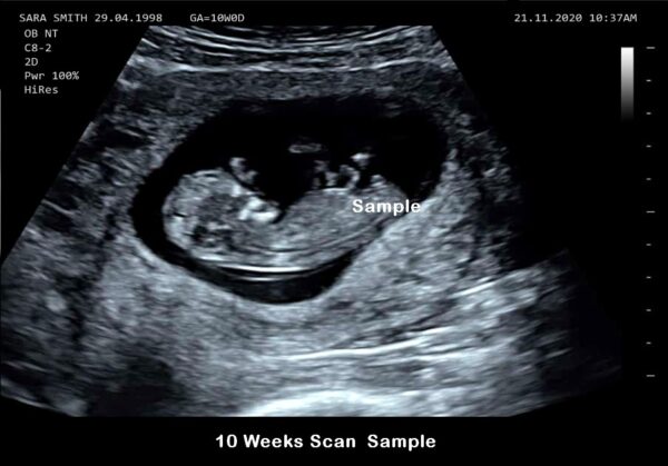 fake baby scan 10 weeks